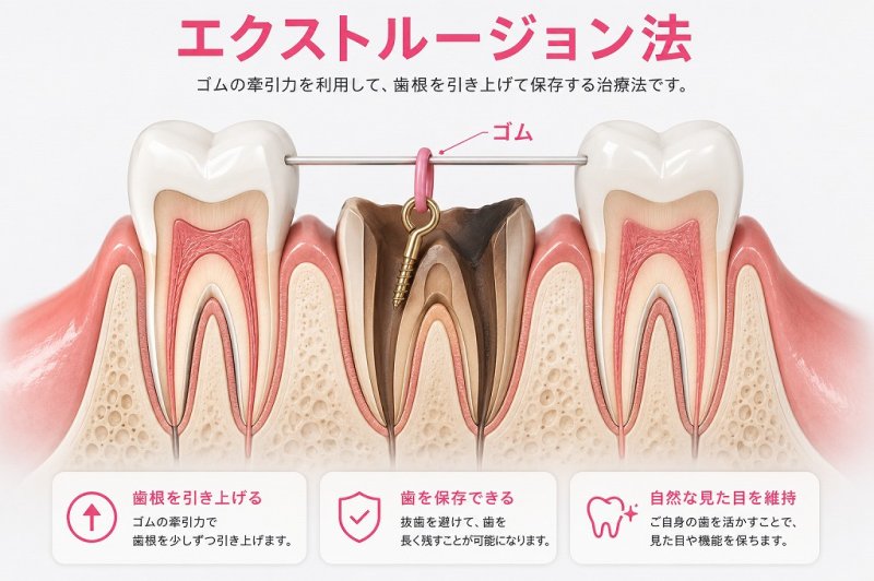 歯を抜かない治療とは?保存治療で天然歯を残す方法と適応 ニュース画像1