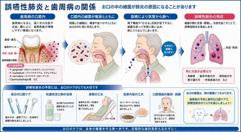 誤嚥性肺炎と歯周病の関係｜口腔内細菌が肺炎を引き起こす ニュース画像1
