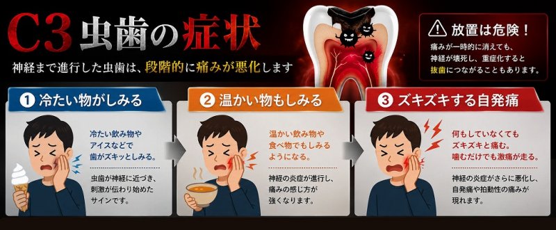 虫歯C3とは？神経まで達した重度虫歯の特徴・症状・治療 ニュース画像1